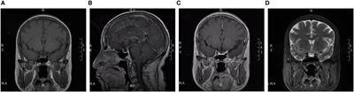 Secondary adrenocortical insufficiency after treatment with retifanlimab: a case report